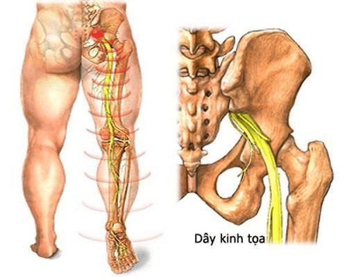 Bệnh đau dây thần kinh toạ