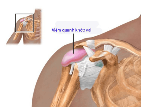 Bệnh viêm quanh khớp vai có triệu chứng nguy hiểm