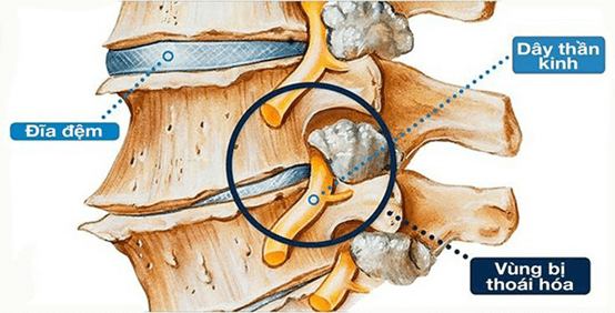 Biến chứng của thoái hoá đốt sống lưng rất nguy hiểm