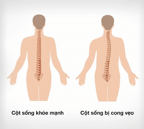 Biểu hiện của bệnh cong vẹo cột sống