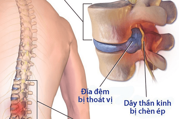 Biểu hiện của bệnh thoát vị đĩa đệm