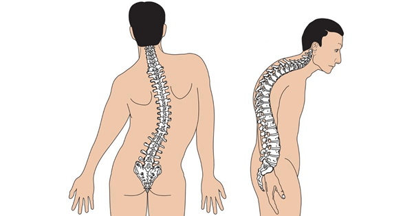 Biểu hiện của cong vẹo cột sống