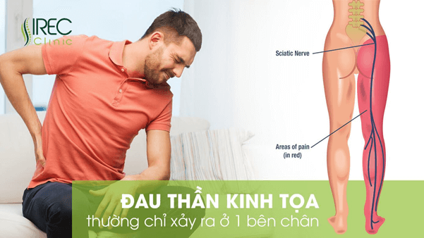 Các biểu hiện thường gặp của đau dây thần kinh tọa