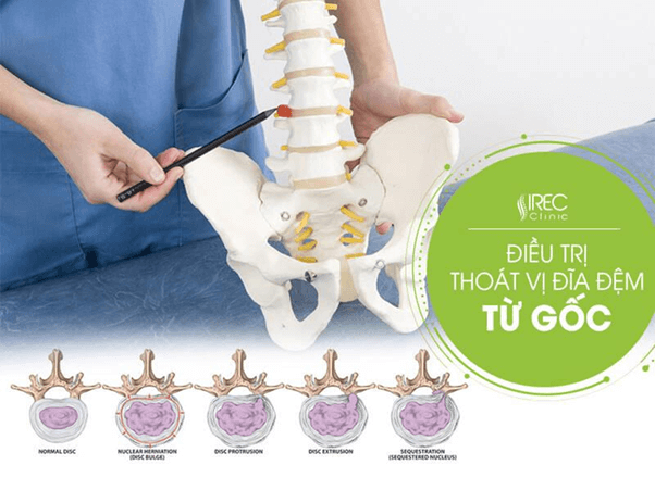 Cách chữa bệnh thoát vị đĩa đệm l5 s1 an toàn từ IREC