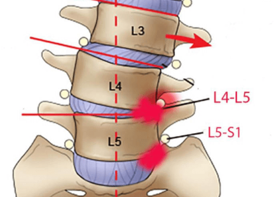 Dấu hiệu của thoát vị đĩa đệm L4 L5