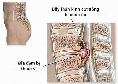 Dấu hiệu nhận biết căn bệnh thoát vị đĩa đệm l4 l5