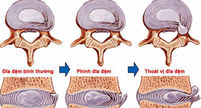 Dấu hiệu nhận biết phình đĩa đệm và thoát vị đĩa đệm