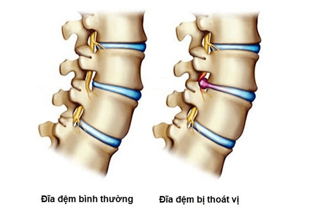 Dấu hiệu nhận biết thoát vị đĩa đệm