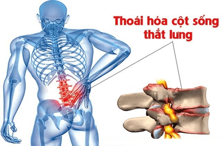 Dấu hiệu thoái hoá cột sống thắt lưng