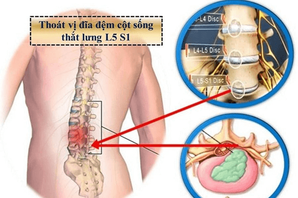 Điều trị thoát vị đĩa đệm L5 S1 kịp thời mang lại hiệu quả cao