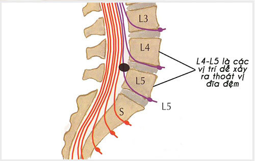 L4 L5 là các vị trí dễ xảy ra thoát vị đĩa đệm