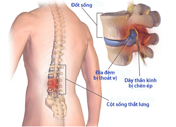 Nắn chỉnh cột sống là một phương pháp điều trị hiệu quả, an toàn