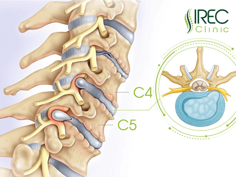 Phòng khám IREC chữa bệnh thoát vị đĩa đệm c4 c5 uy tín