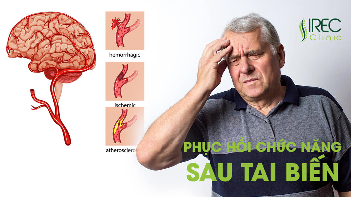 Phục hồi chức năng sau tai biến