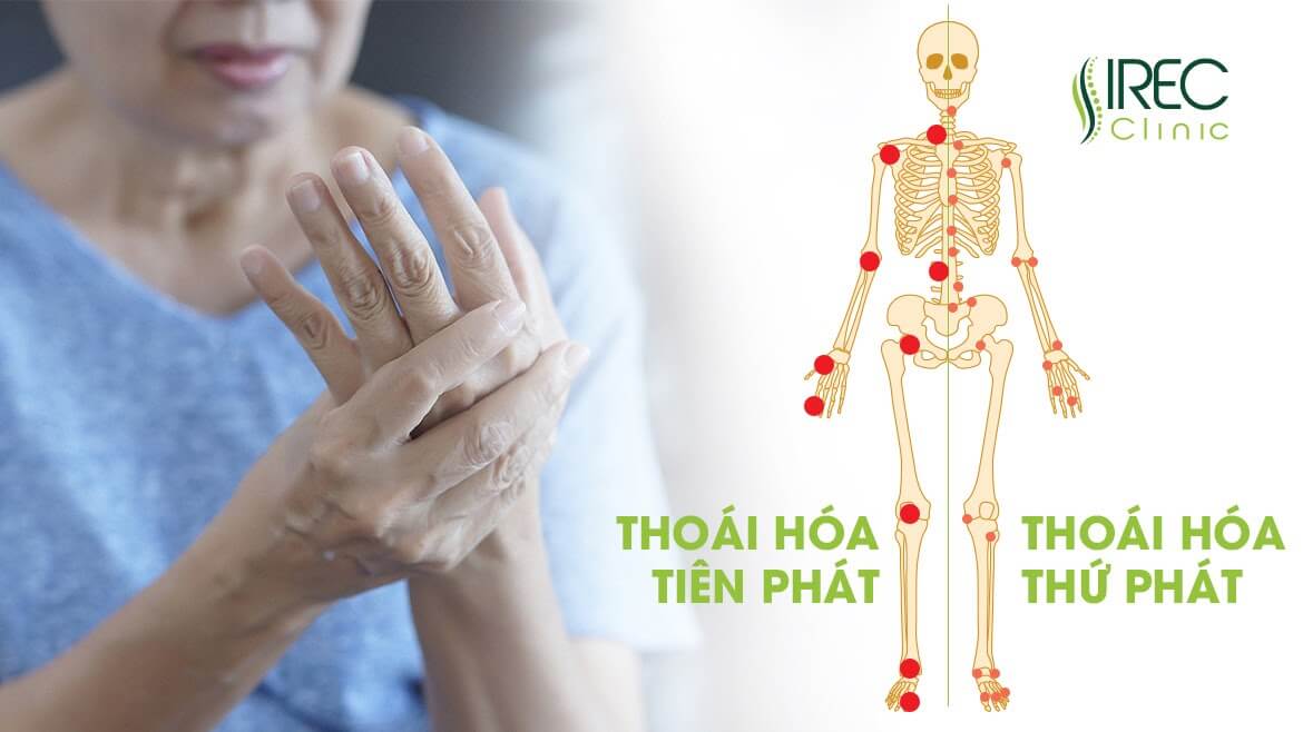 Thoái hóa xương khớp