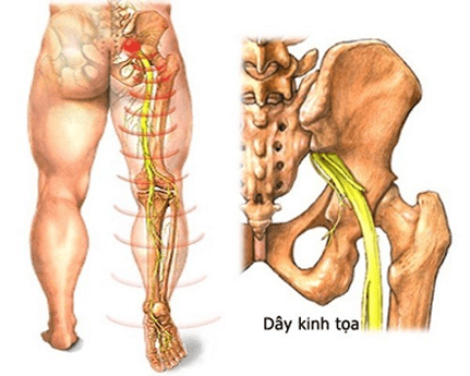 Triệu chứng của bệnh đau dây thần kinh toạ