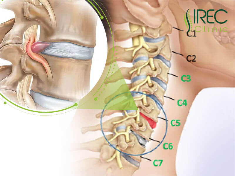 Vị trí của bệnh thoát vị đĩa đệm C5 C6 trong cơ thể