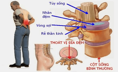 Vị trí của đĩa đệm trong cơ thể