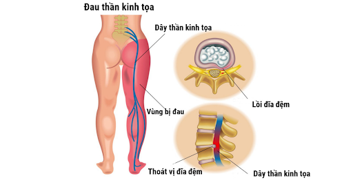 Bệnh đau thần kinh tọa là nỗi ám ảnh với rất nhiều người