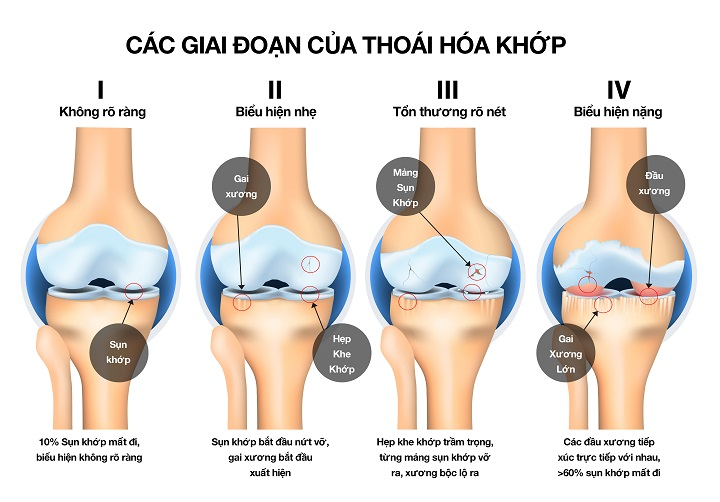 Các giai đoạn của thoái hoá khớp