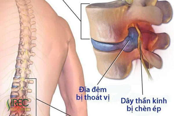 Đau lưng, cứng lưng cũng là một trong những biểu hiện thoát vị đĩa đệm cột sống thắt lưng