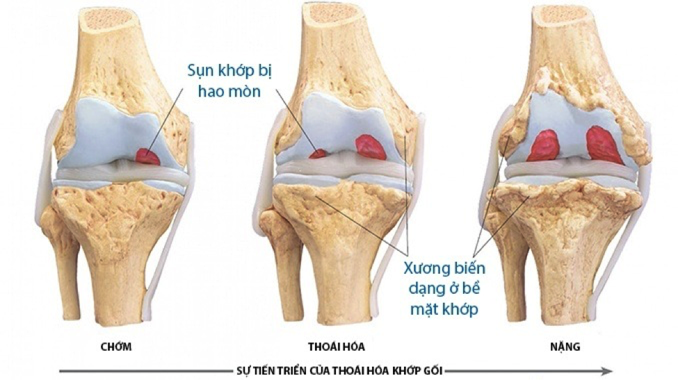 Hình ảnh diễn biến của thoái hóa khớp gối