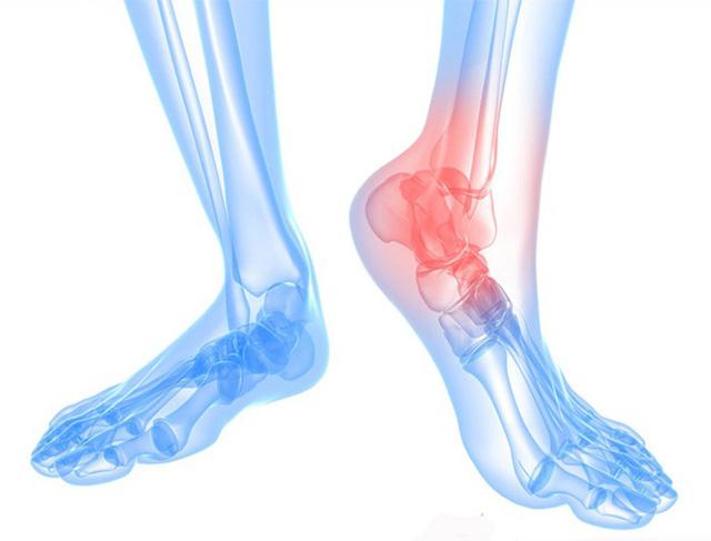 Hình ảnh minh họa vị trí Bệnh thoái hóa xương gót chân