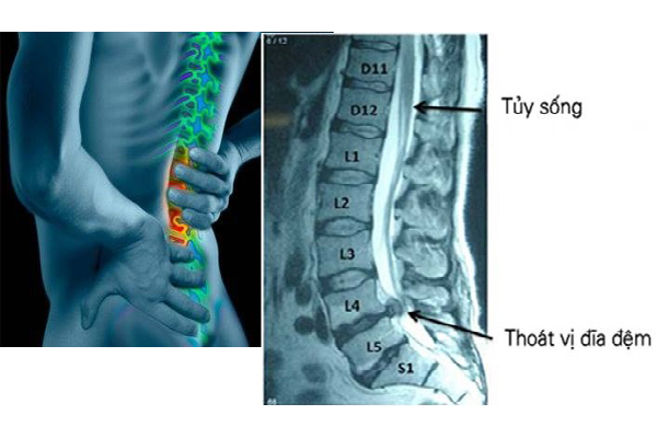 Phương pháp chẩn đoán chụp X-Quang cột sống