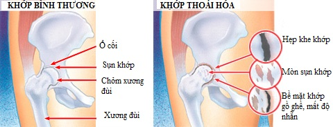 Thoái hóa xương khớp háng đang trở thành những cơn đan ám ảnh người bệnh