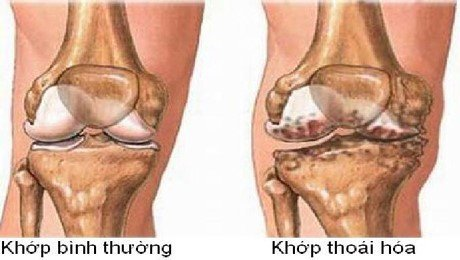 Thoái hóa xương khớp là bệnh gì?