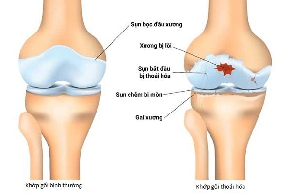 Thoái hóa xương khớp làm giảm vận động của người bệnh