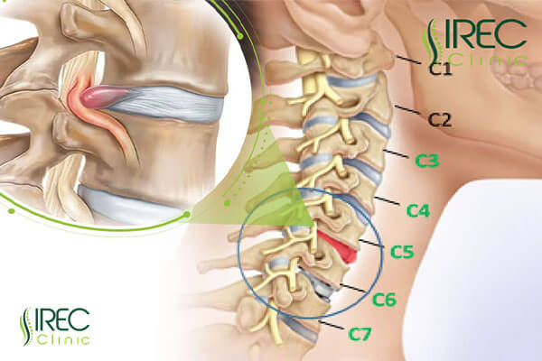 Thoát vị đĩa đệm cột sống cổ đang trở nên phổ biến với người đang trong độ tuổi lao động