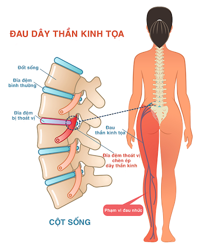 Thoát vị đĩa đệm là nguyên nhân chính gây nên đau thần kinh tọa