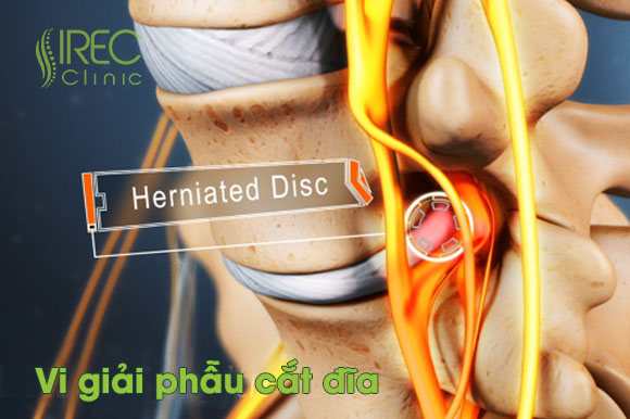 Vi giải phẫu cắt đĩa microdiscectomy