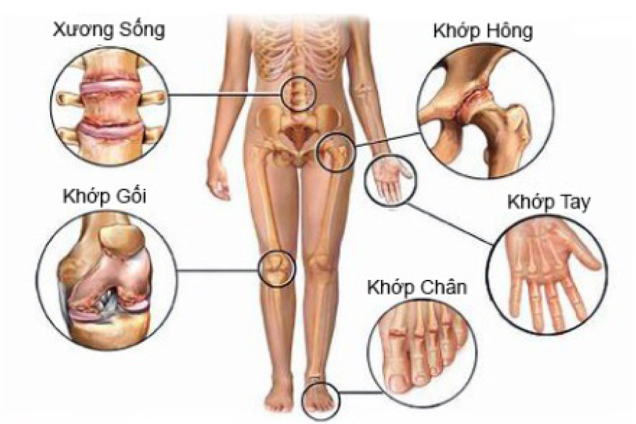 Vị trí các khớp thường diễn ra thoái hóa